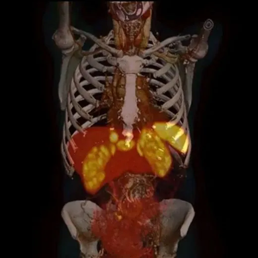 PET-CT de cuerpo completo