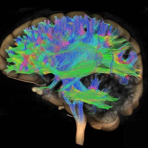 Resonancia magnética de cerebro
